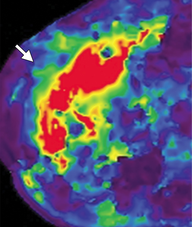 Dysplastic nodule in segment V of the liver